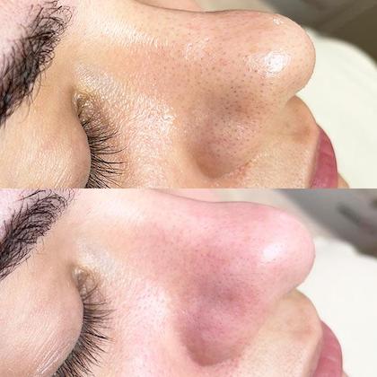 Комбінована чиста обличчя Київ Комбінована чиста обличчя Київ