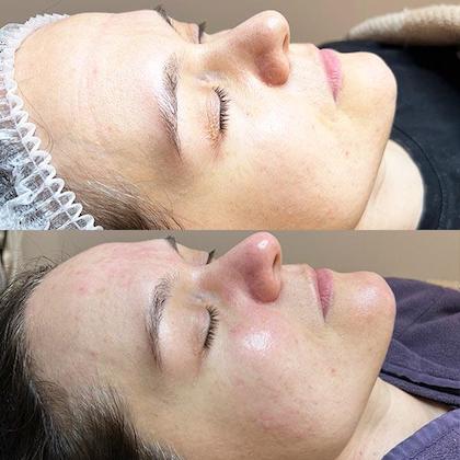 Комплексна чистка обличчя Київ Комплексна чистка обличчя Київ