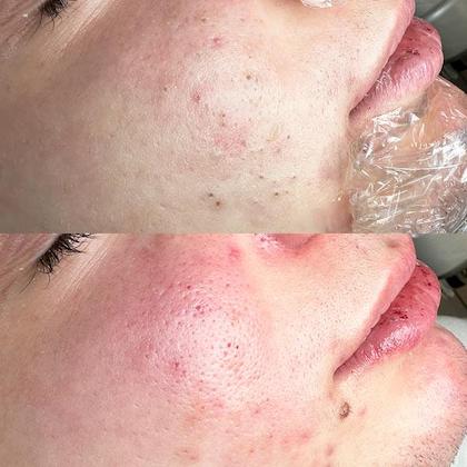 Чистка обличчя Київ Чистка обличчя Київ