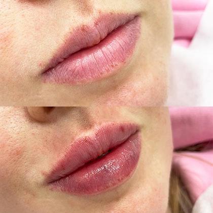 Контурна пластика губ Київ