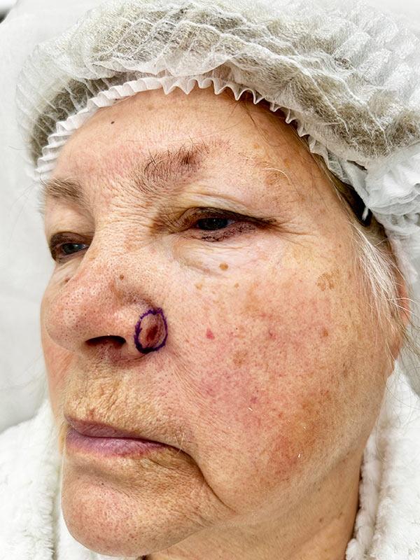 Видалення базальноклітинного раку шкіри Київ