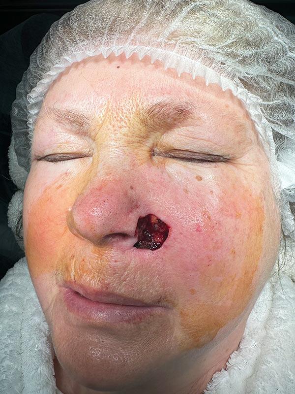 Видалення БКК методом Mosh Київ