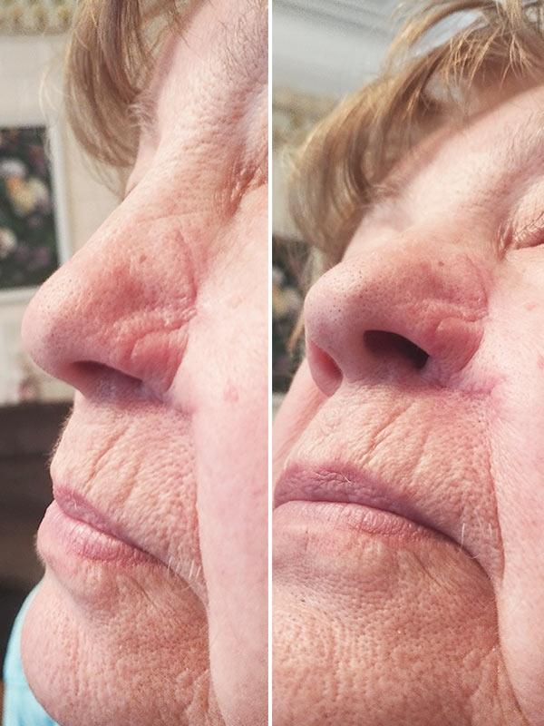 Хирургическое удаление по Mosh базальноклеточного рака Киев Хирургическое удаление базальноклеточного рака по Mosh Киев