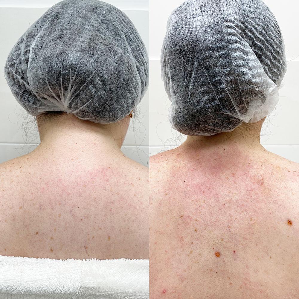 Липосакция вдовьего горба Киев