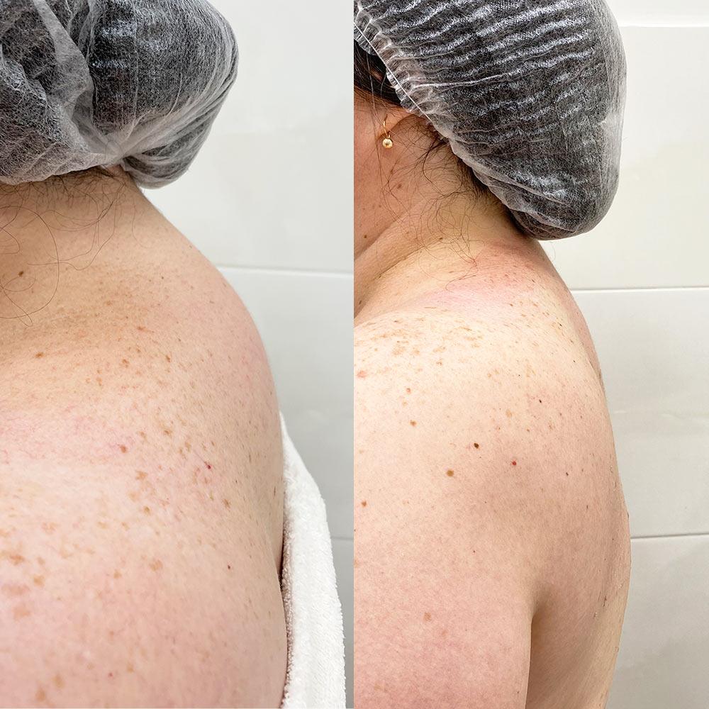 Ліпосакція холки Київ