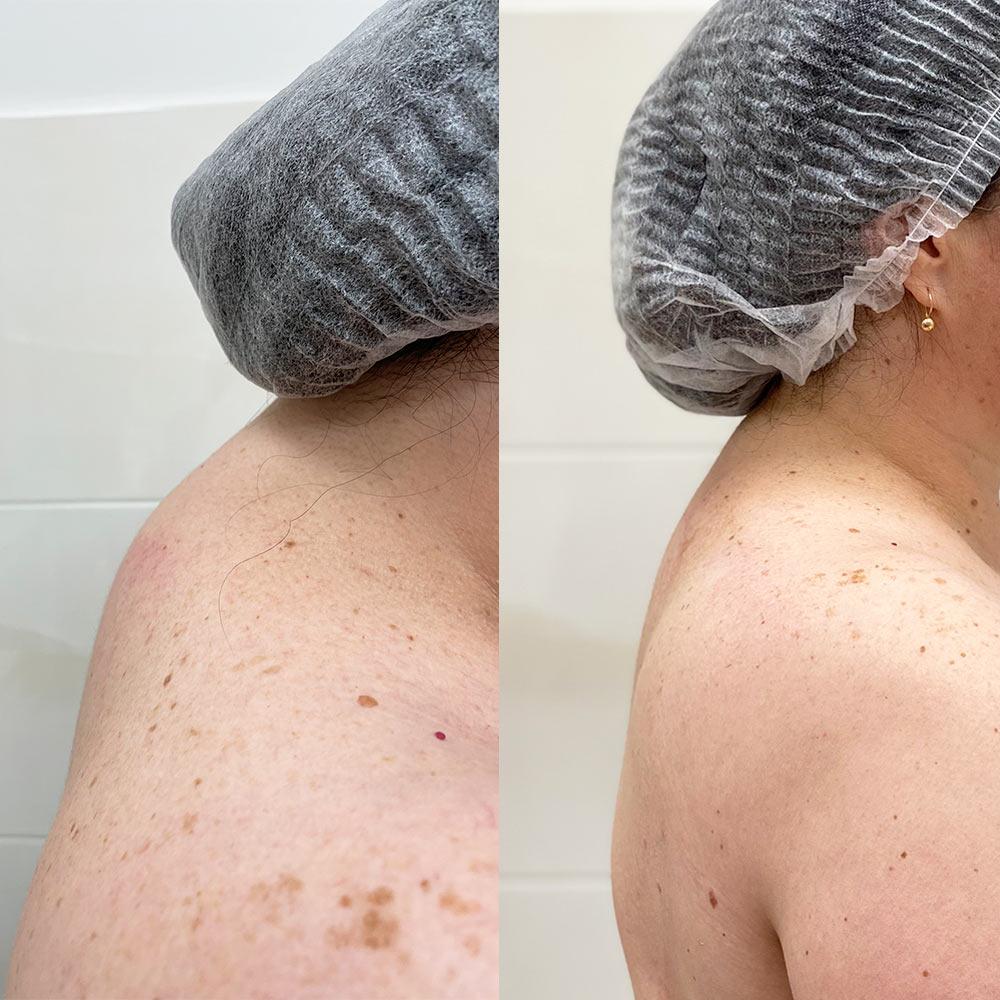 Удаление вдовьего горба Киев