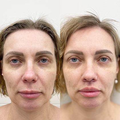 Блефаропластика + Хейлопластика Булхорн Київ