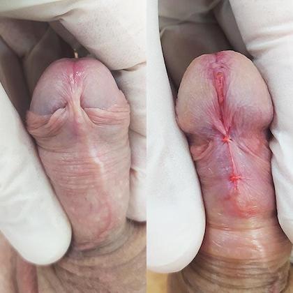 Пластика уздечки Киев