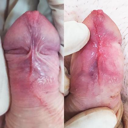 Пластика уздечки – уролог Киев