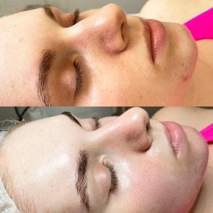 PRX T33 Київ – лікар косметолог Губатюк В.А.