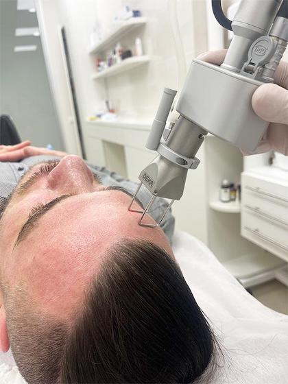 Лазерний СО2 пілінг Київ