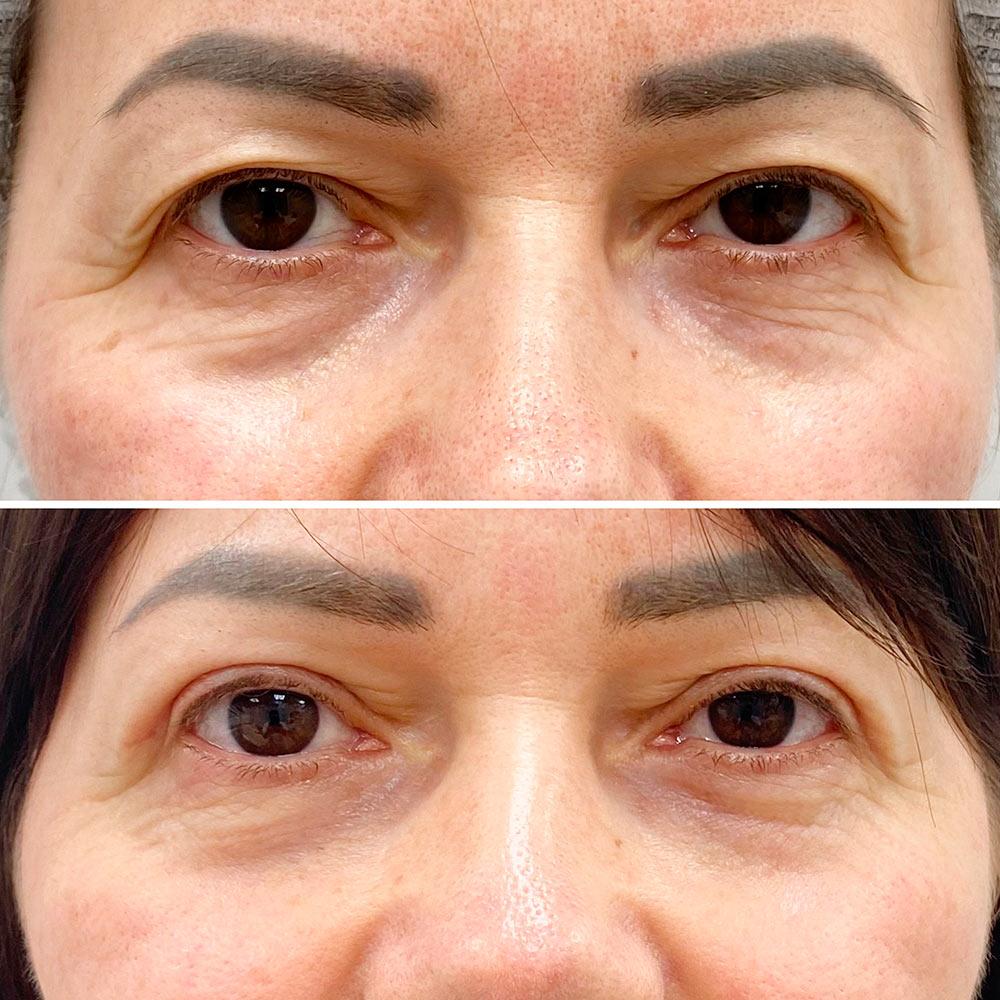 Верхня блефаропластика Київ