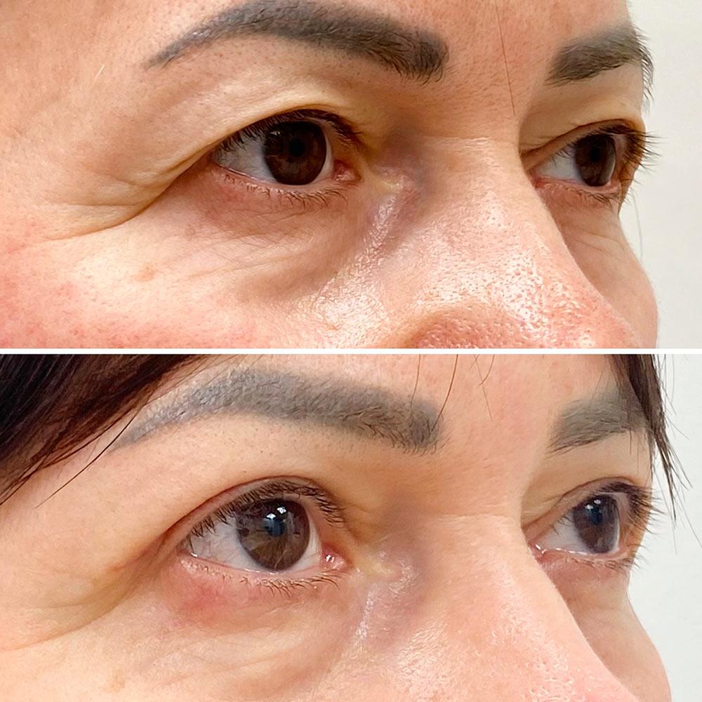 Верхня блефаропластика Київ