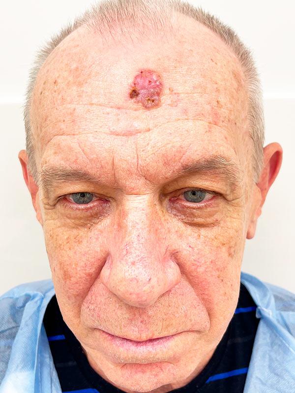 Хірургія MOC при базаліомі шкіри Київ