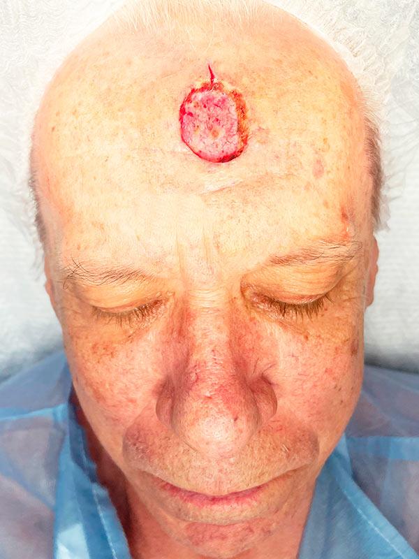 Видалення базаліоми методом Mosh Київ