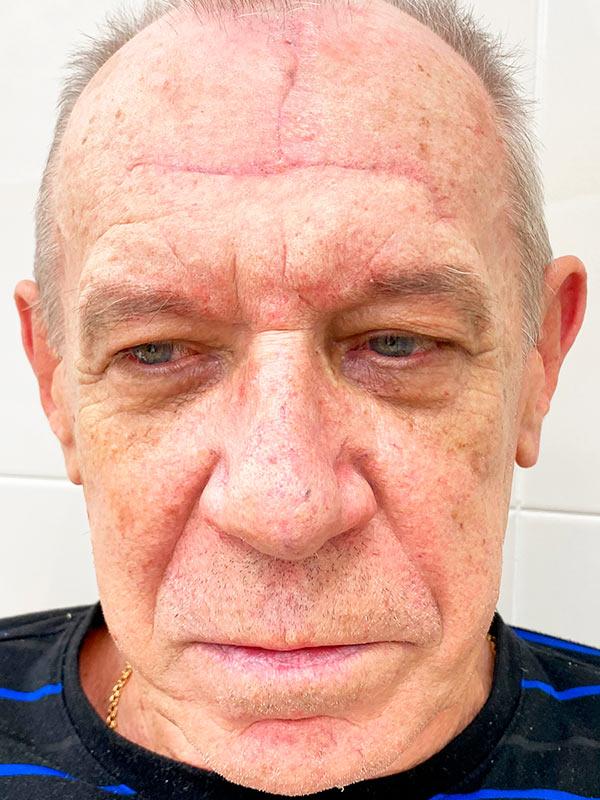 Результат видалення базаліоми методом Mosh Київ