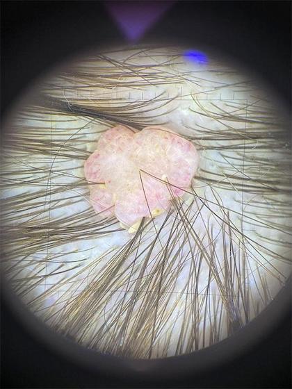 Дерматоскопія родимки Київ