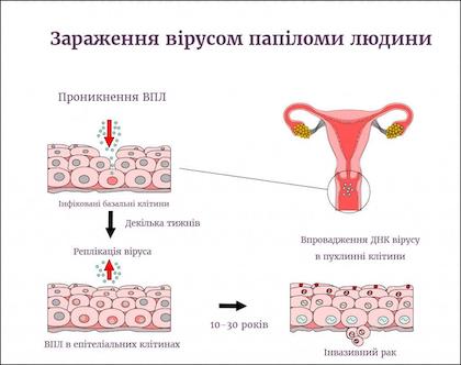 Вірус папіломи людини