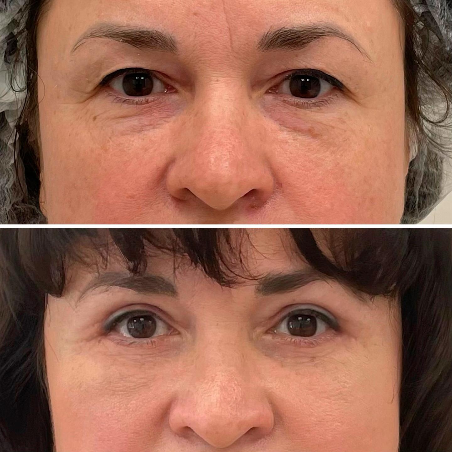 Верхня блефаропластика Київ