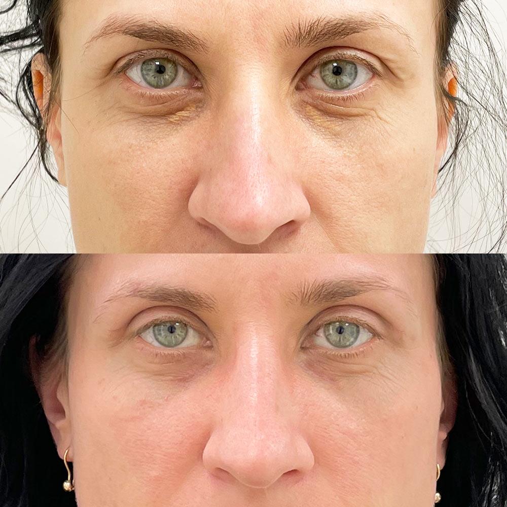 Блефаропластика Киев