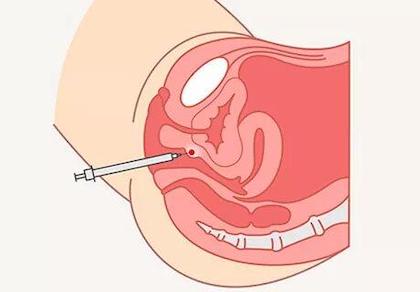 Аугментація точки G філером гіалуронової кислоти