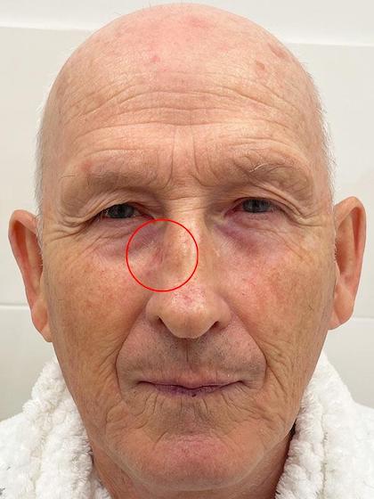 Mosh хірургія при рецидиві базаліоми Київ