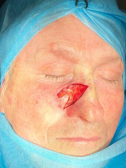 Видалення злоякісного утворення методом Mosh Київ