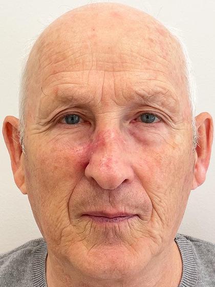 Видалення базаліоми методом Mosh Київ