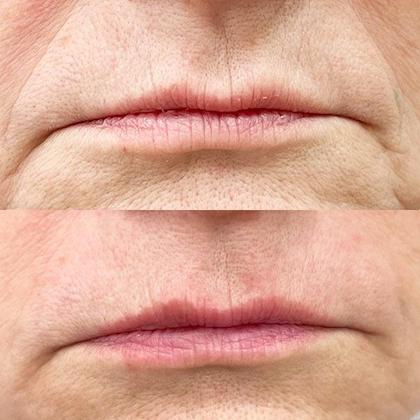 Бланшинг дермальних заломів Київ