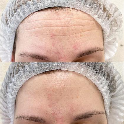 Диспорт область лоба – лікар косметолог Губатюк В.А.