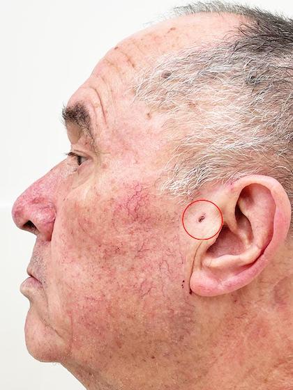 Видалення базаліоми Mosh Киев