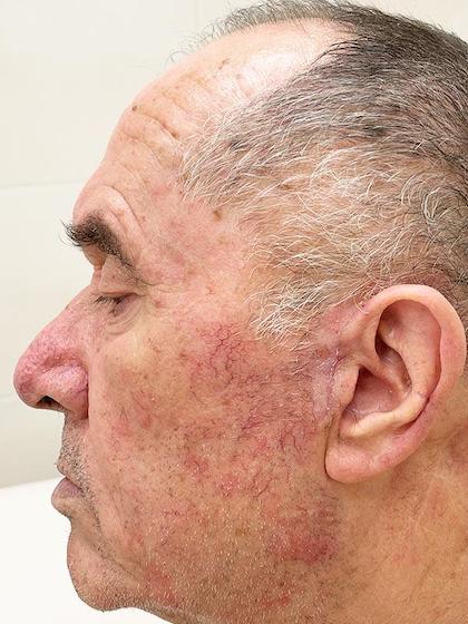 Оперативне лікування раку шкіри Mosh Київ