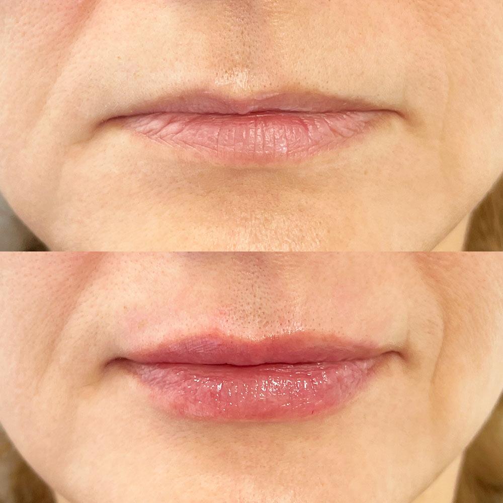 Контурная пластика губ – Увеличение губ Киев Контурная пластика губ – Увеличение губ Киев