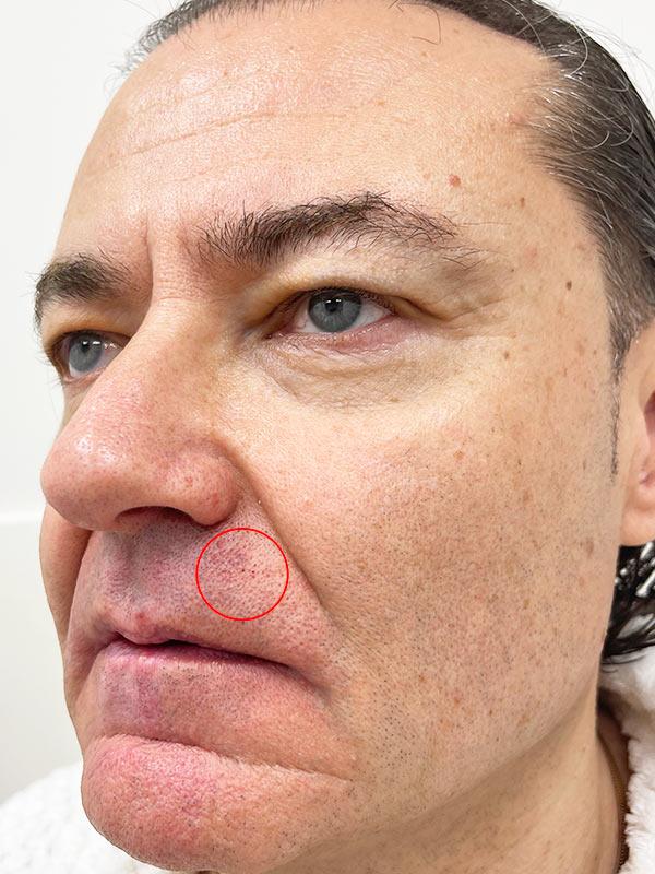 Видалення базальноклітинної карциноми шкіри Київ