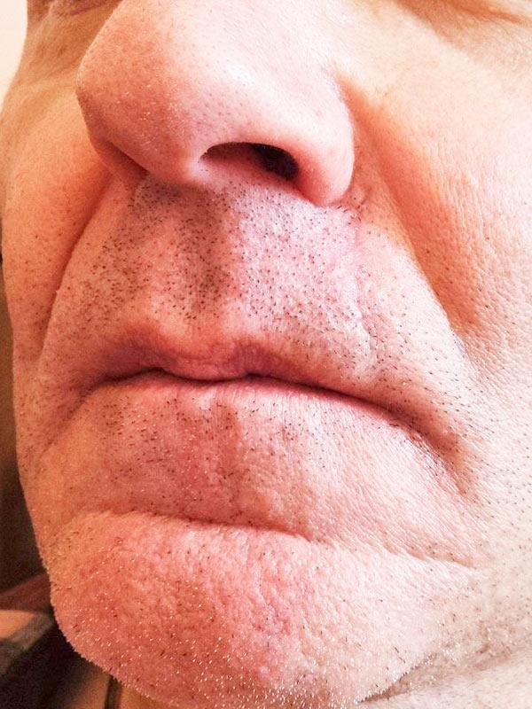 Результат удаление БКК методом Mosh Киев Результат удаление БКК методом Mosh Киев