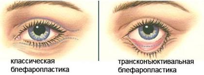 Блефаропластика век