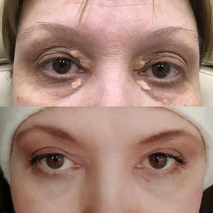 Видалення ксантоми ксантелазми повік + блефаропластика Київ