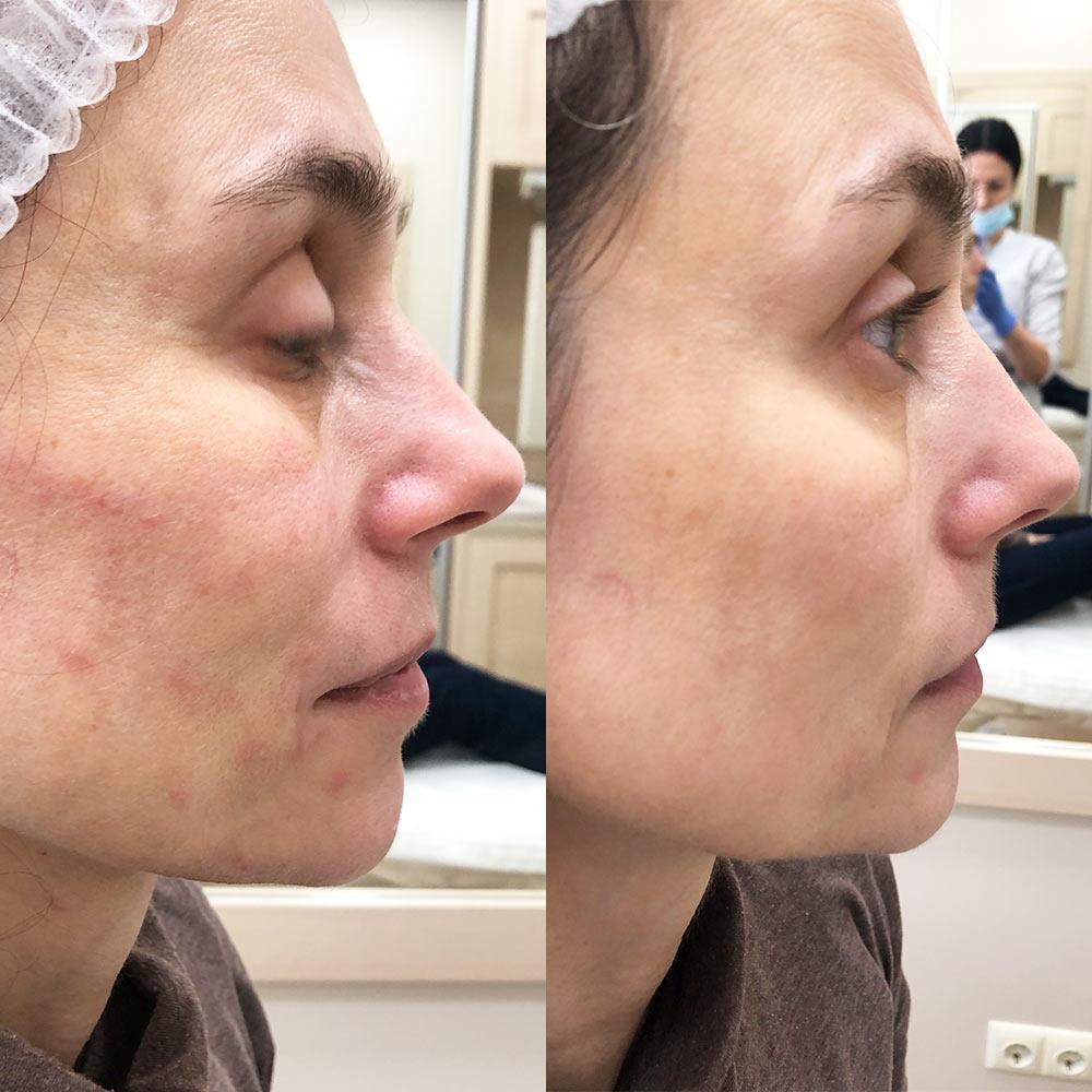 Биоревитализация RRS LONG LASTING 3 ml