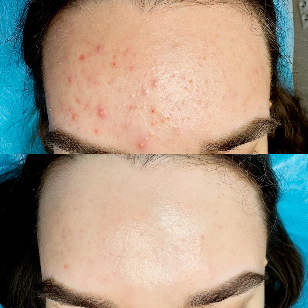 Лікування акне Київ