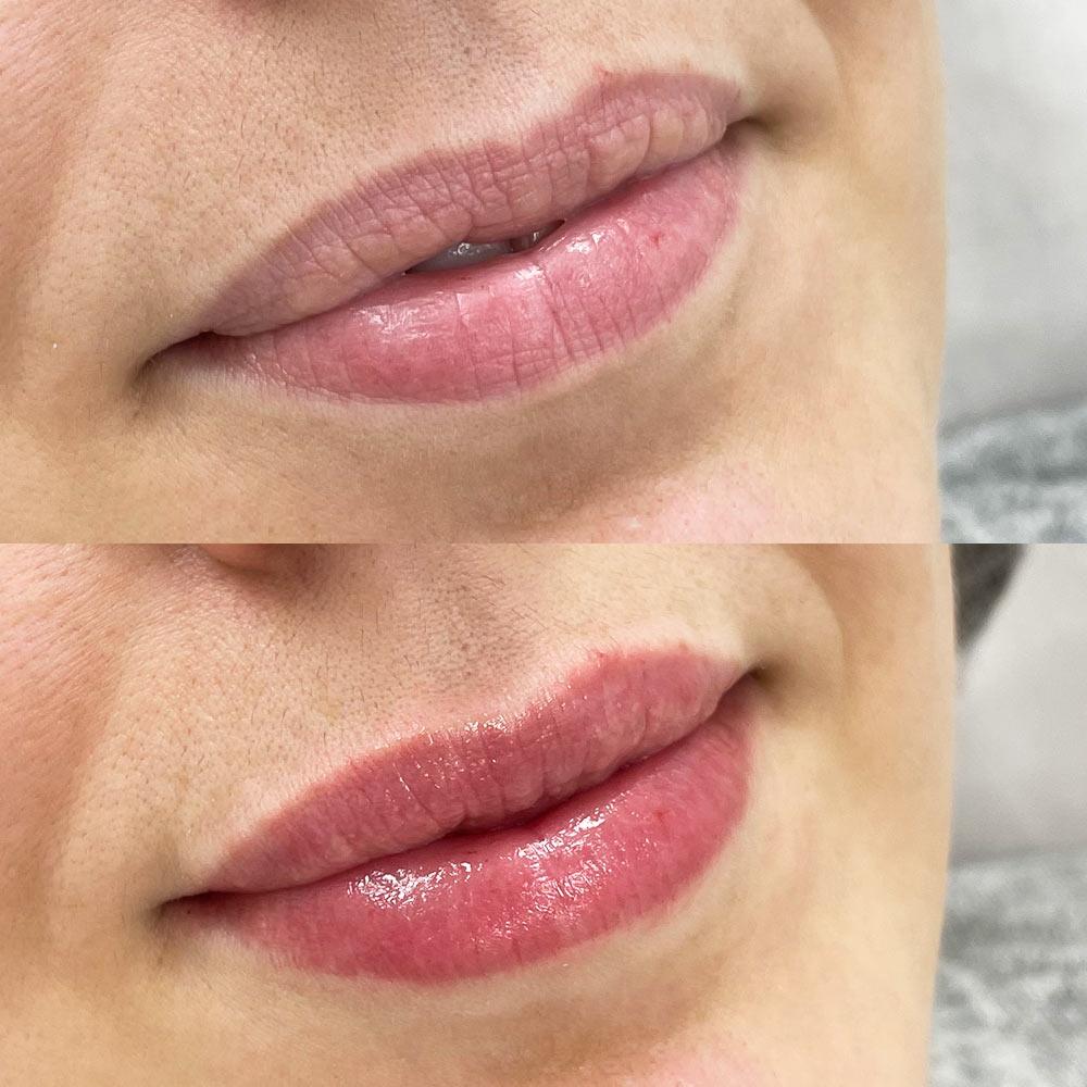 Контурна пластика губ – Київ