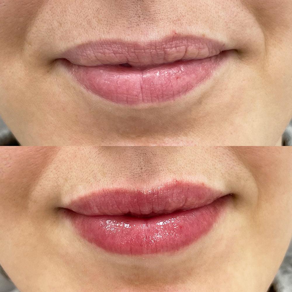 Контурна пластика губ – зволоження губ Київ