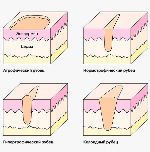 Види рубців