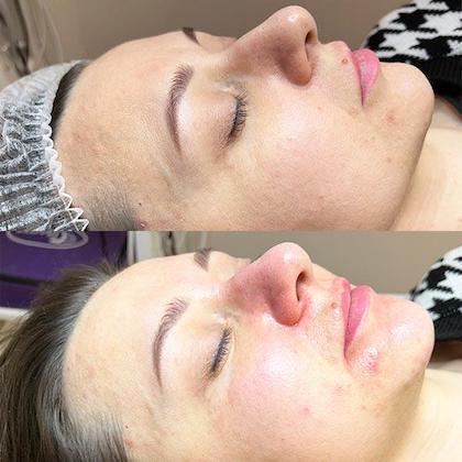 abr пілінг Київ