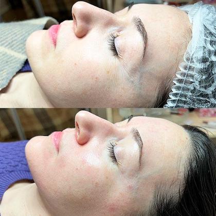 ABR чистка обличчя Київ