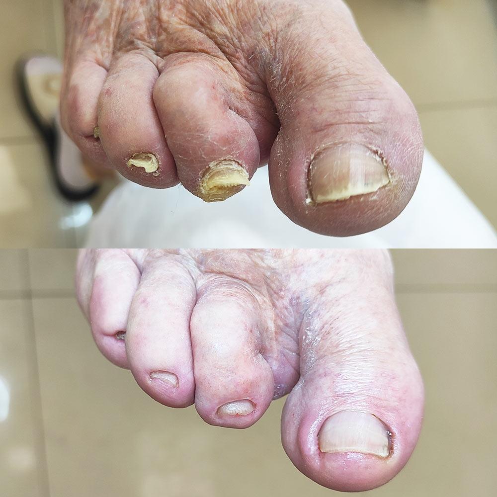 Медицинский педикюр SUDA Киев