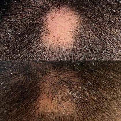 Лечение алопеции Киев