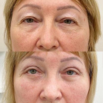 Кругова блефаропластика повік Київ