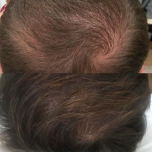 Мезотерапія – лікування випадіння волосся Київ Мезотерапія – лікування випадіння волосся Київ