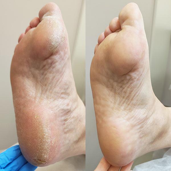 Медичний педикюр – догляд за стопами Київ