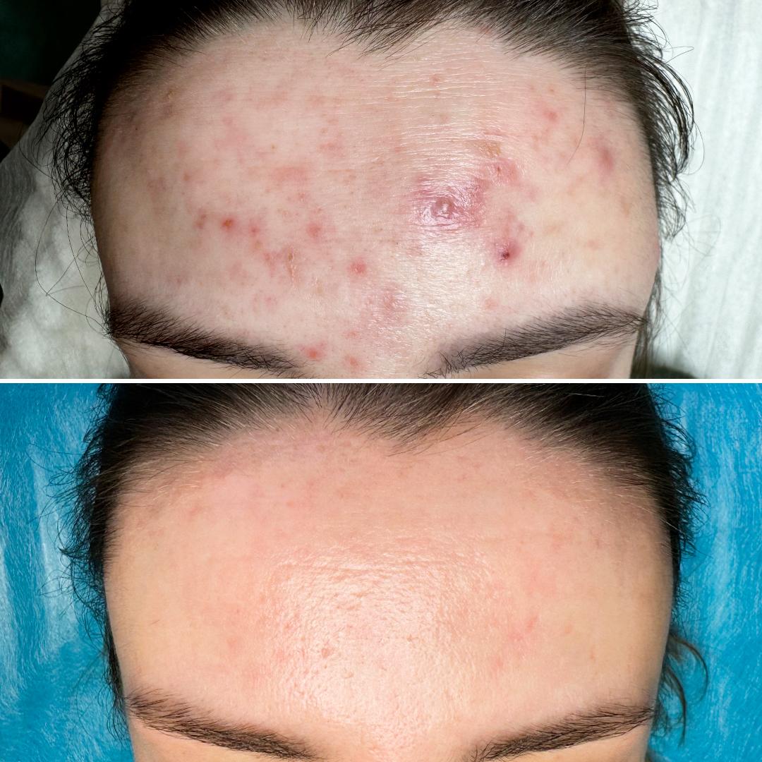 Результат лікування акне Київ